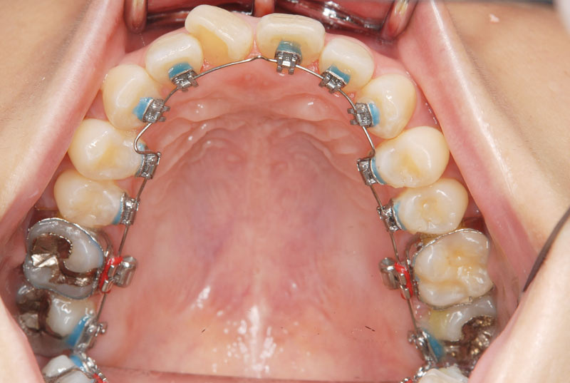 舌側矯正內側觀