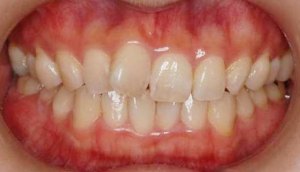 舌側矯正正面觀