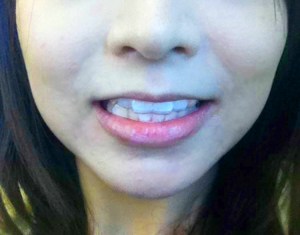 戴上透明牙托近觀