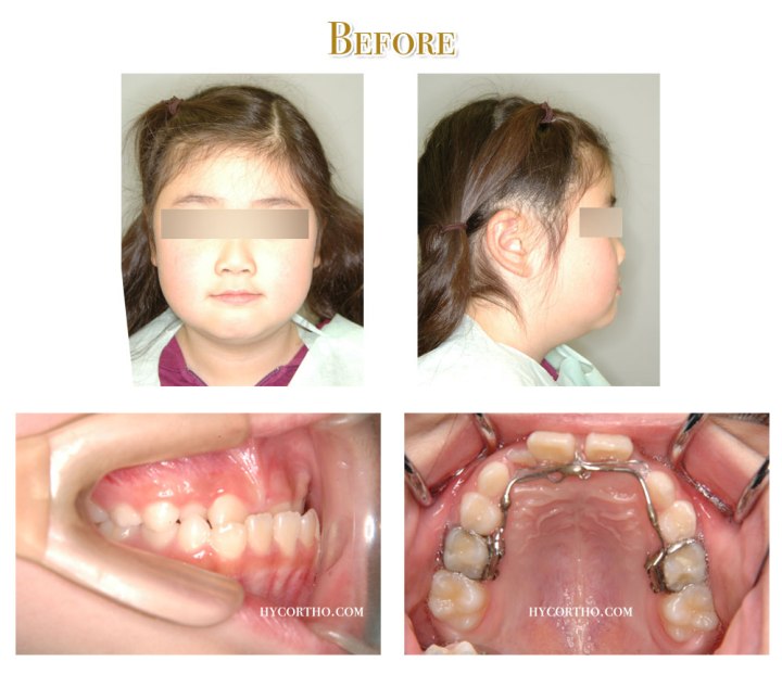 矯正前臉部正面、側面、口內、舌側弧線矯正裝置