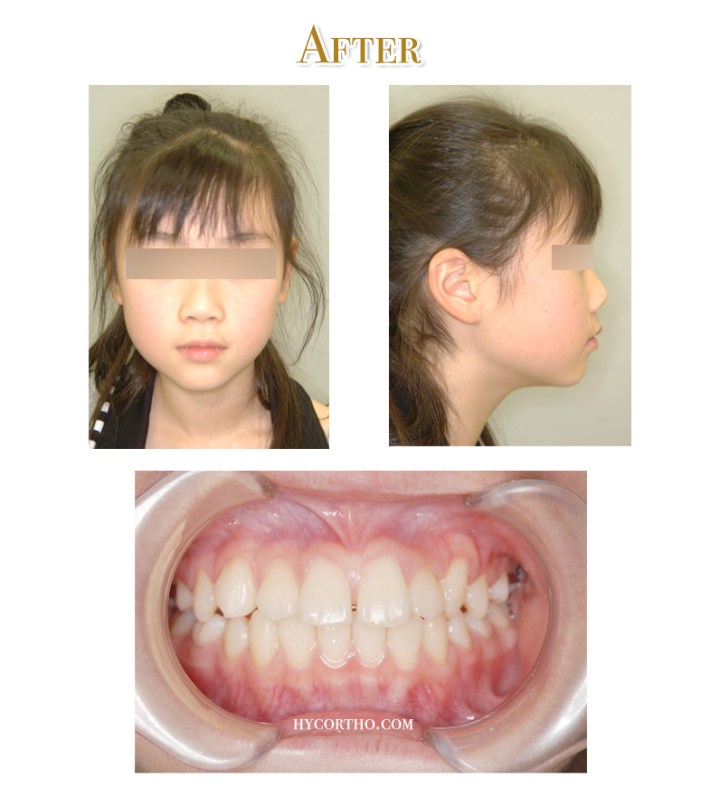 矯正後臉部正面、側面、口內照片