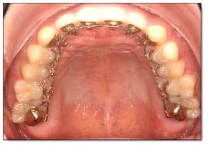 圖三 A,3M Incognito舌側矯正口內觀