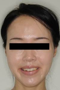 圖三B,3M Incognito舌側矯正治療中外觀