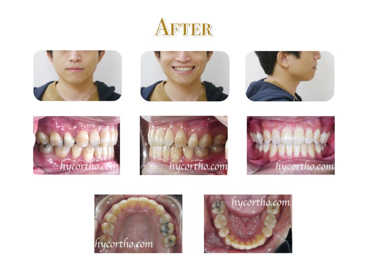 隱形舌側矯正治療後