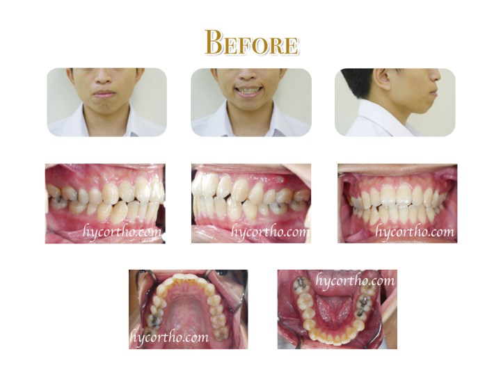 隱藏式舌側矯正治療前