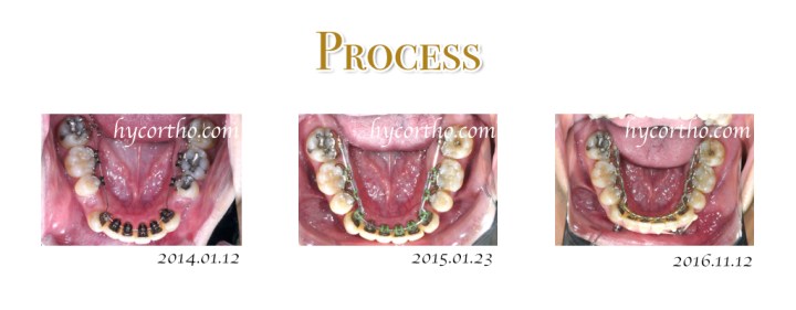 隱藏式舌側矯正治療過程