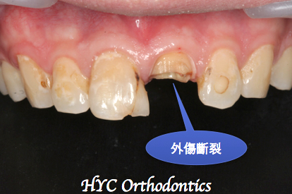 病人撞斷的左上正中的門牙