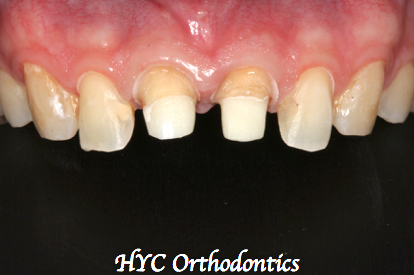 病人因此下定決心，一次把前面四顆門牙都美化