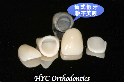 中間兩顆是全瓷牙冠，旁邊兩顆是瓷牙貼片