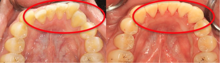 下顎咬合面口內照