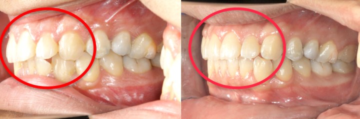 側方咬合口內照（左圖為治療前，右圖為治療後）