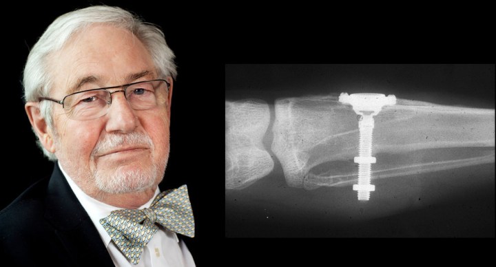 Per-Ingvar Brånemark 發現鈦金屬與骨頭有密接作用