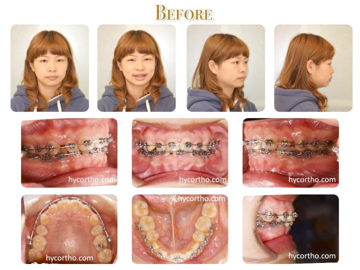 可愛的美眉治療前