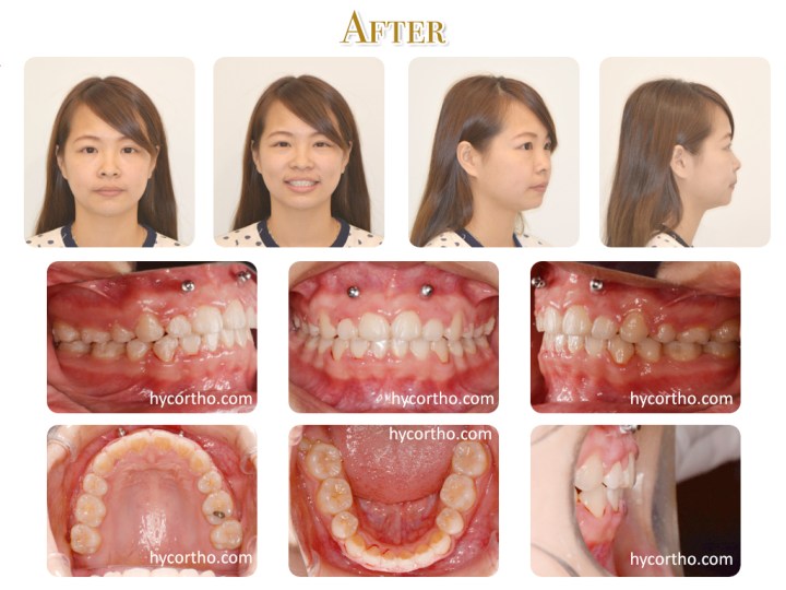 可愛的美眉治療後