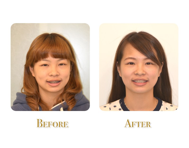 可愛的美眉治療前後(正面)