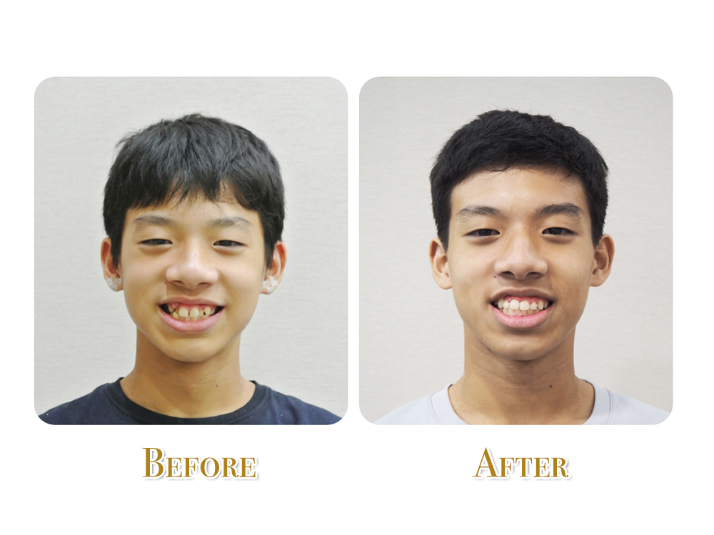 不拔牙矯正治療