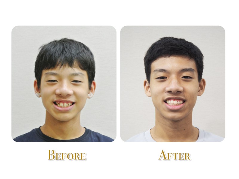 不拔牙矯正治療