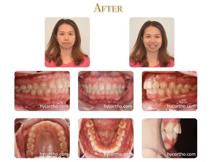 黃郁芩醫師 牙齒矯正案例 矯正後