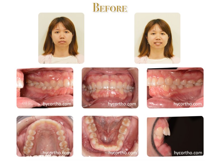 黃郁芩醫師 牙齒矯正案例 矯正前