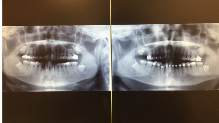 右下犬齒漸漸冒出