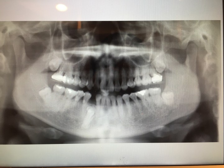 右下犬齒被擋住