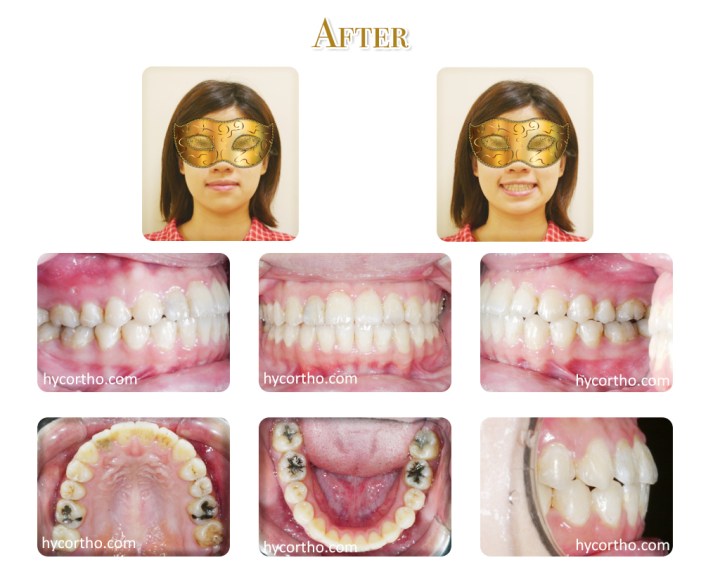 黃郁芩醫師矯正案例 矯正後