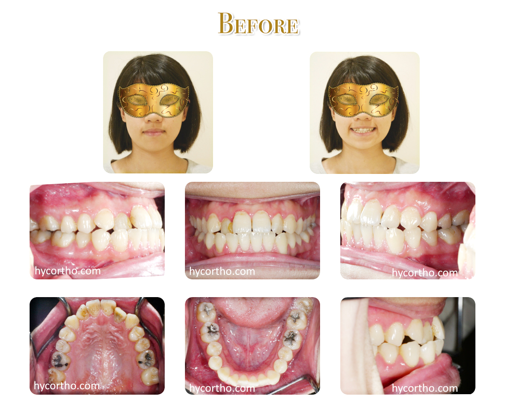 黃郁芩醫師 牙齒矯正案例 矯正前