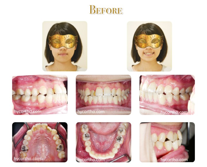 黃郁芩醫師 牙齒矯正案例 矯正前