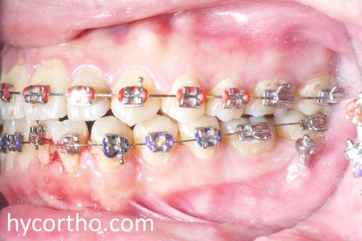 黃郁芩醫師使用迷你骨釘