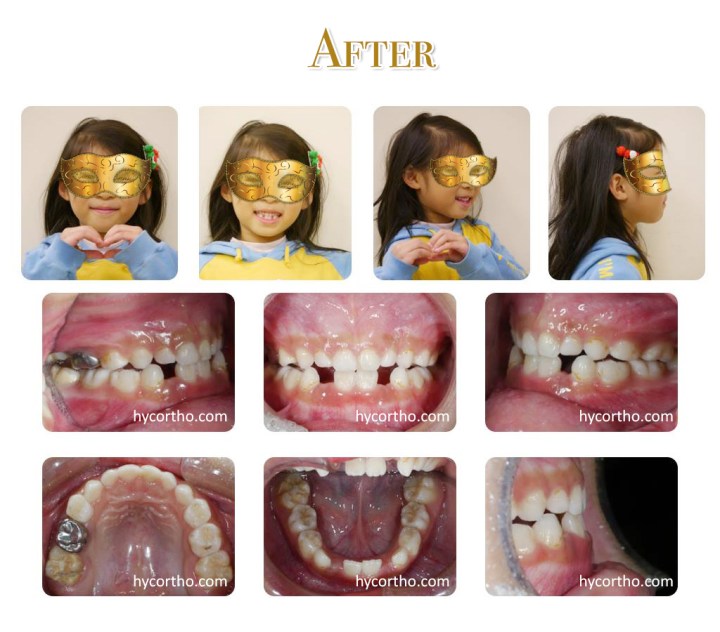 黃醫師的快樂小小朋友 - 戽斗治療後