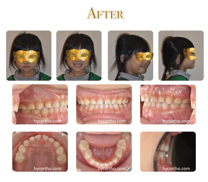 黃醫師的另一位快樂小小朋友 - 戽斗治療後