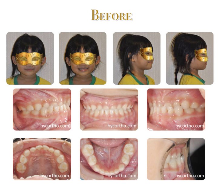 黃醫師的另一位快樂小小朋友 - 戽斗治療後