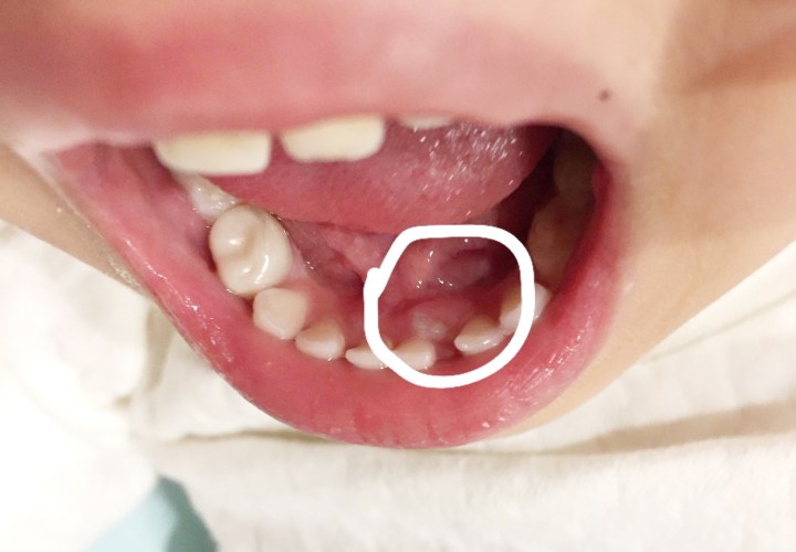 乳牙擋到後面恆牙的成長