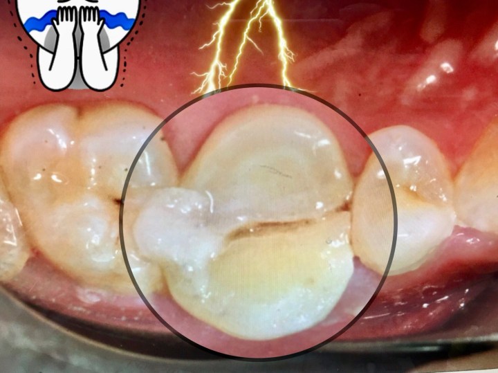 牙齒裂太嚴重...