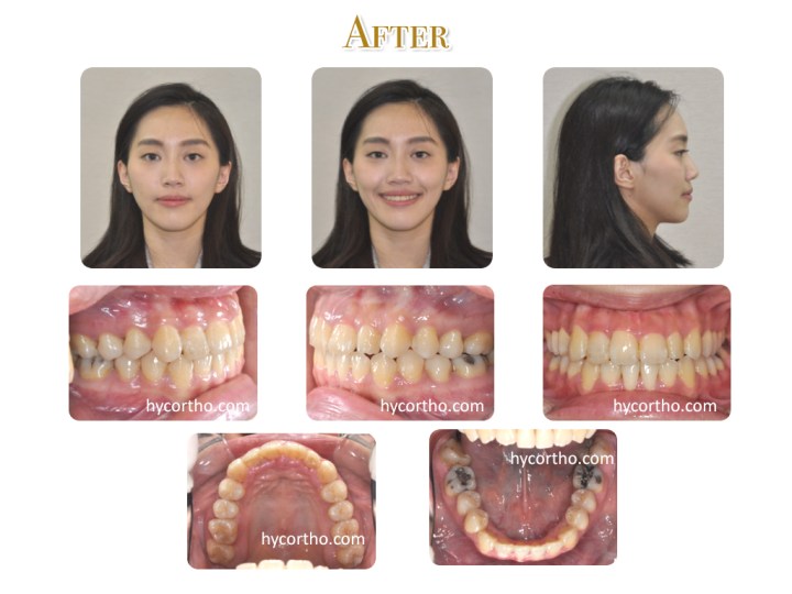 美眉牙齒矯正後
