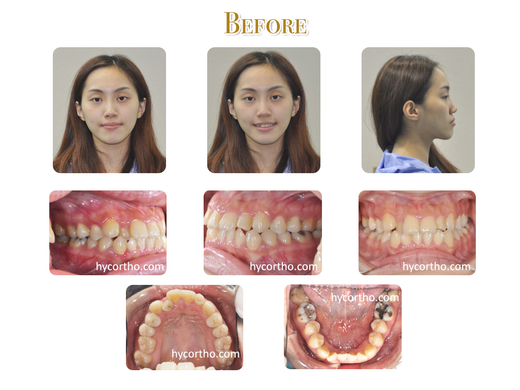 美眉牙齒矯正前